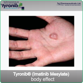 Drug information and side-effects for Tyronib (imatinib mesylate)